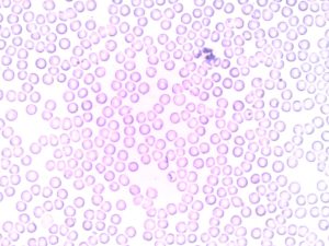 leucemia linfoblastica